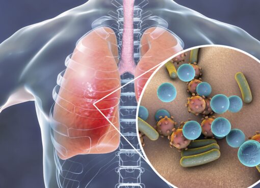 निमोनिया के लक्षण ,कारण और बचाव के उपाय pneumoniae