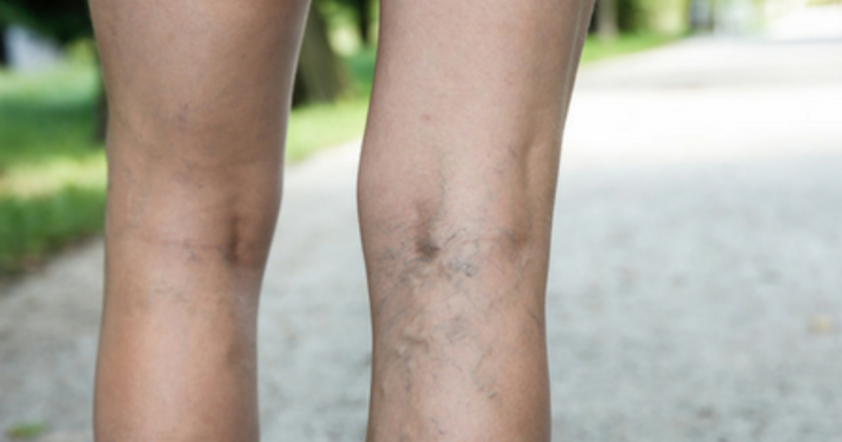 blue vein in legs